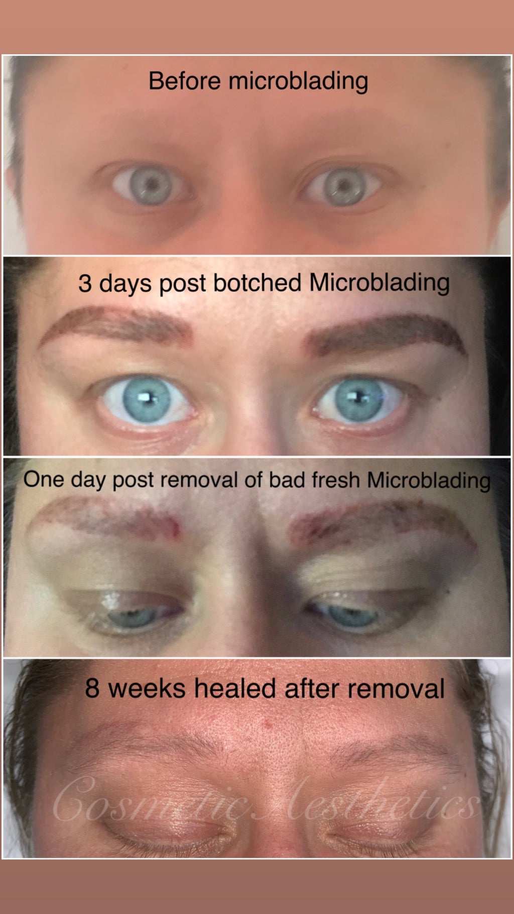 Emergency Removal Webinar for Botched Microblading, Powder brows, Lip Blush and Scalp Micropigmentation