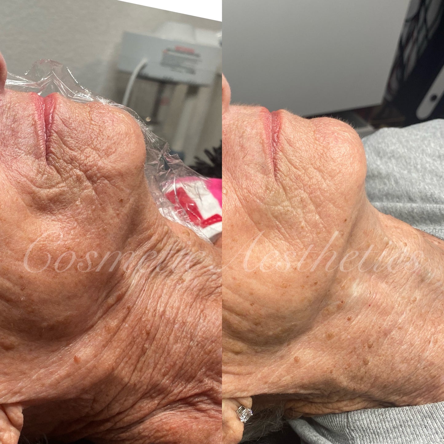 Microchanneling face & neck treatment