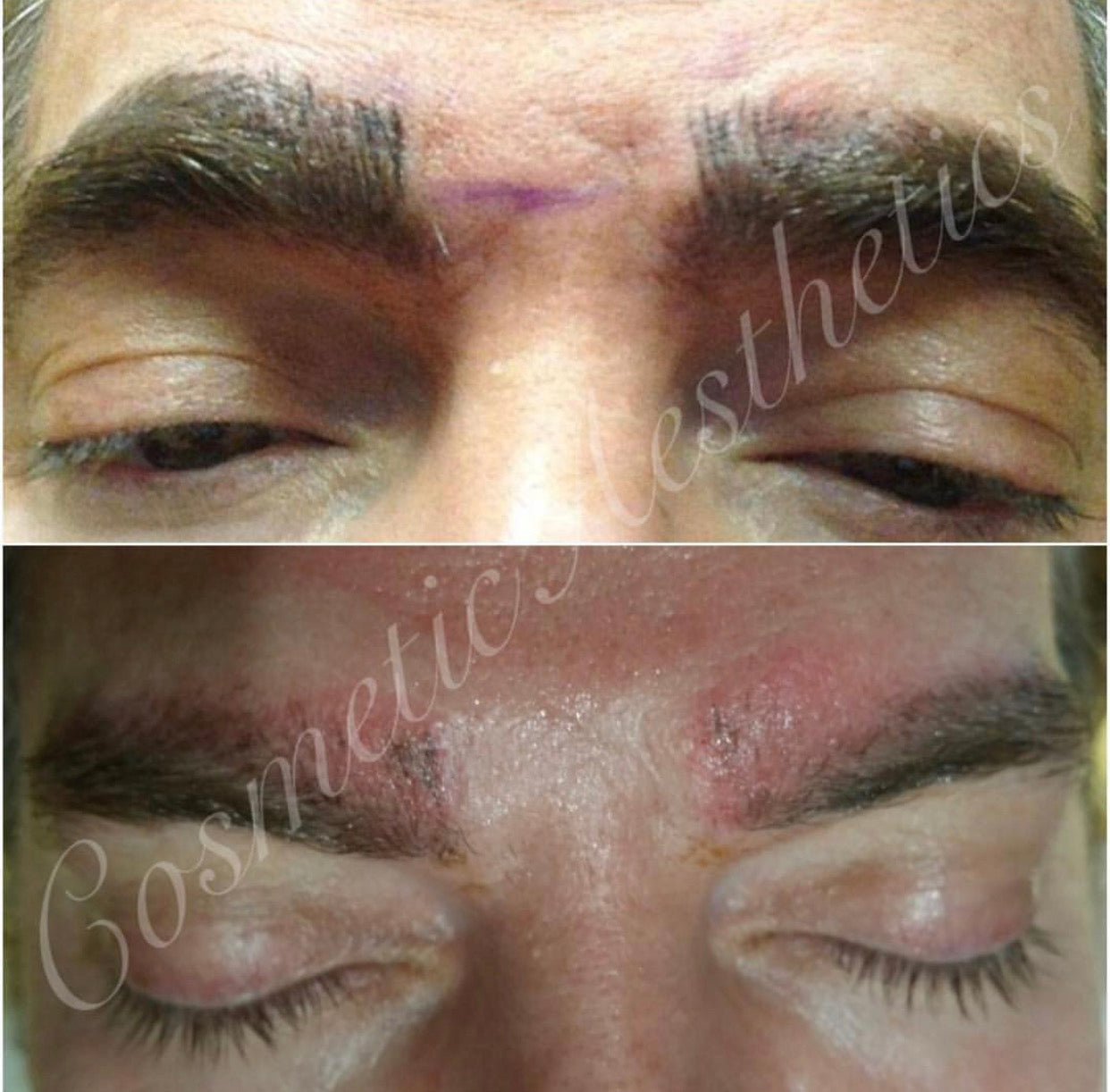 Emergency Removal Webinar for Botched Microblading, Powder brows, Lip Blush and Scalp Micropigmentation