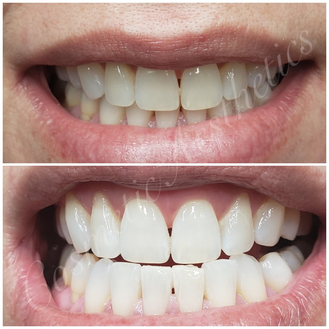 Teeth whitening with a buddy