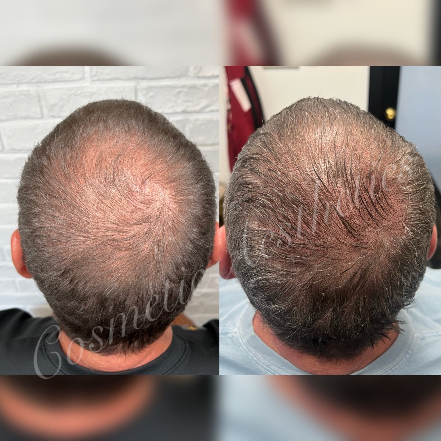 Scalp Micropigmentation half head session