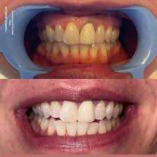 Teeth Whitening